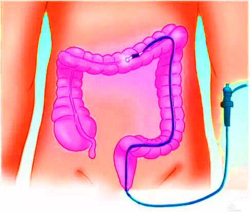 直腸癌早期有哪些癥狀？